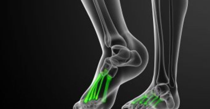 What is a Metatarsal Stress Fracture? image