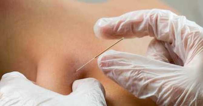 Medical Acupuncture & Dry Needling